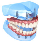 השתלה בזאלית לשחזור מלא של שיניים חסרות - למי זה מיועד?